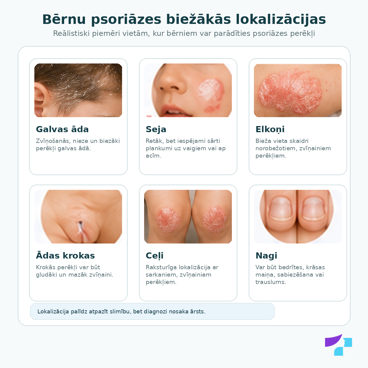 Bērnu psoriāzes biežākās lokalizācijas: galvas āda, seja, elkoņi, ādas krokas, ceļi un nagi