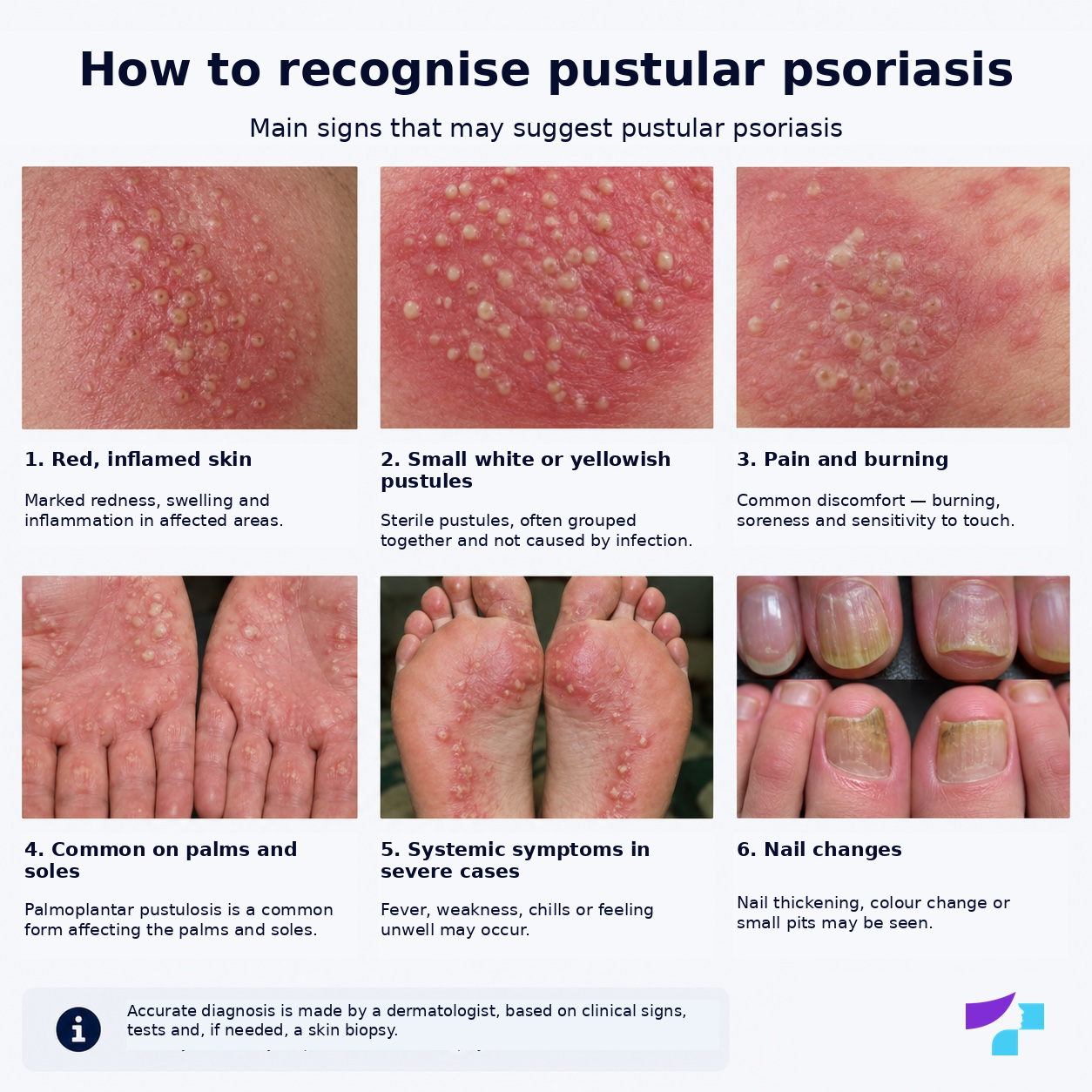 How to recognise pustular psoriasis How to recognise pustular psoriasis: sterile pustules, red skin, pain, burning and possible systemic symptoms