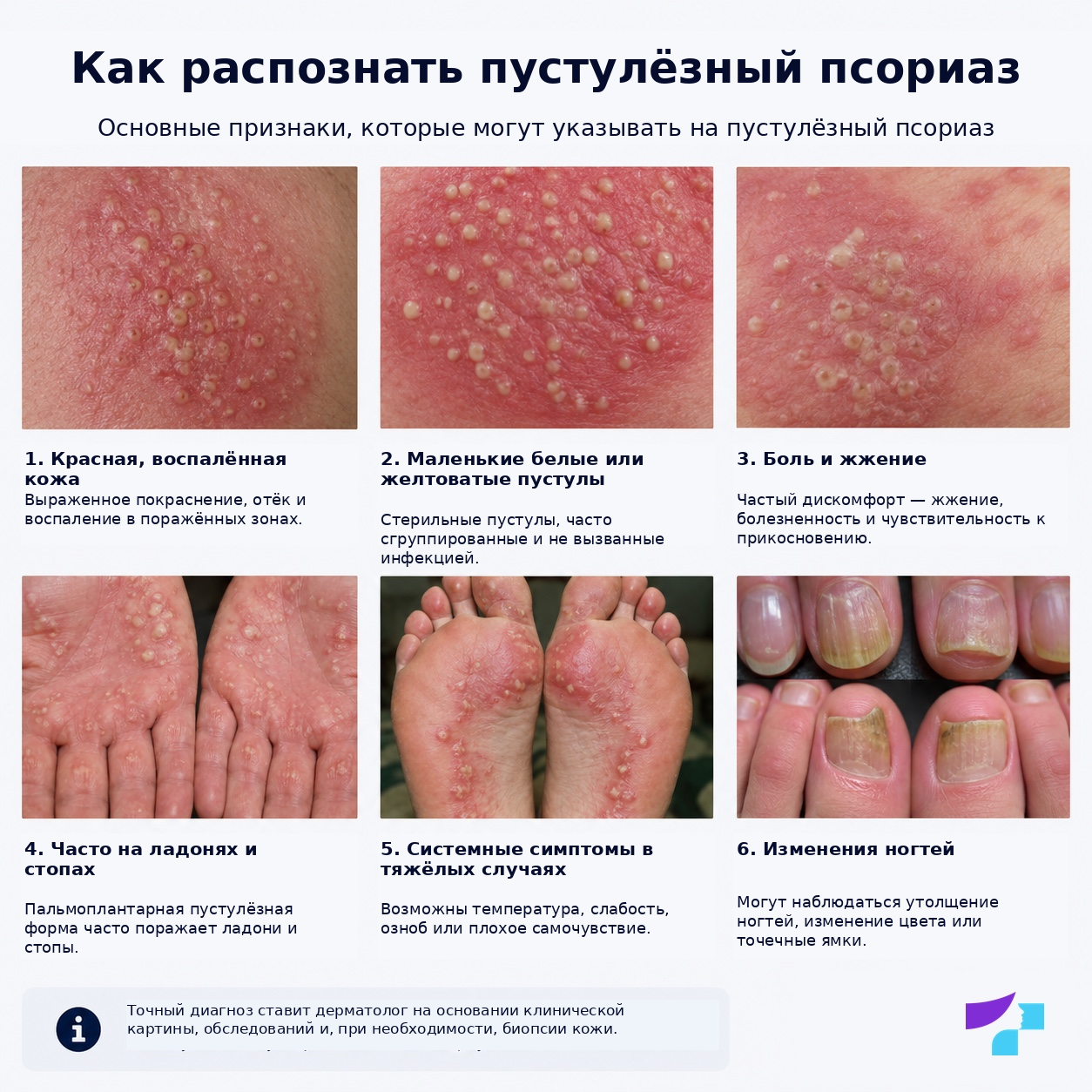 Как распознать пустулёзный псориаз: стерильные пустулы, покрасневшая кожа, боль, жжение и возможные системные симптомы
