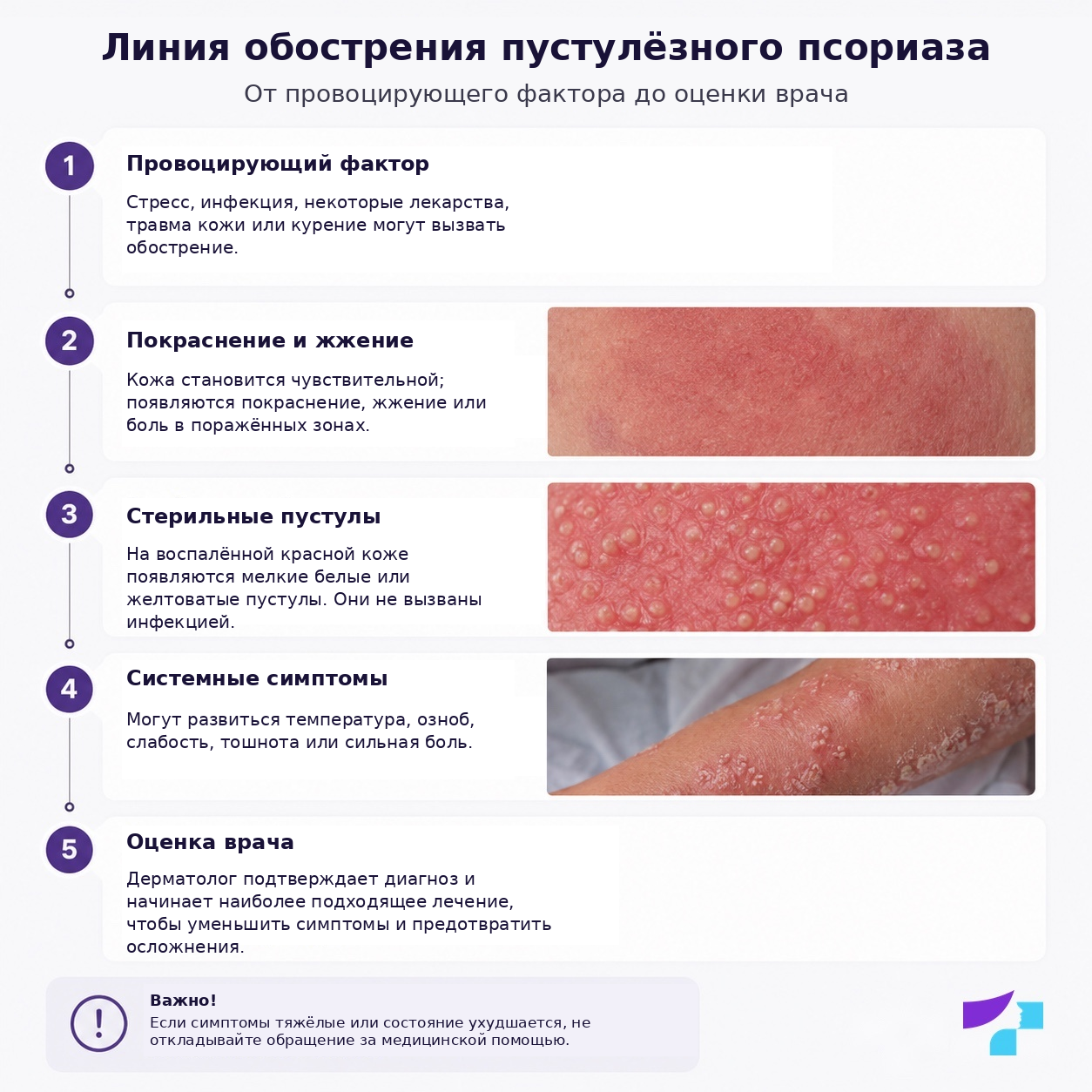 Линия обострения пустулёзного псориаза: провоцирующий фактор, покраснение, стерильные пустулы, системные симптомы и оценка врача