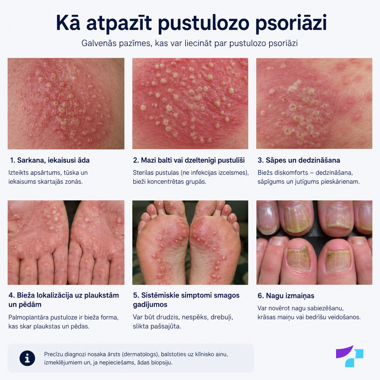 Kā atpazīt pustulozo psoriāzi: sterilas pustulas, apsārtusi āda, sāpes, dedzināšana un iespējamie sistēmiskie simptomi