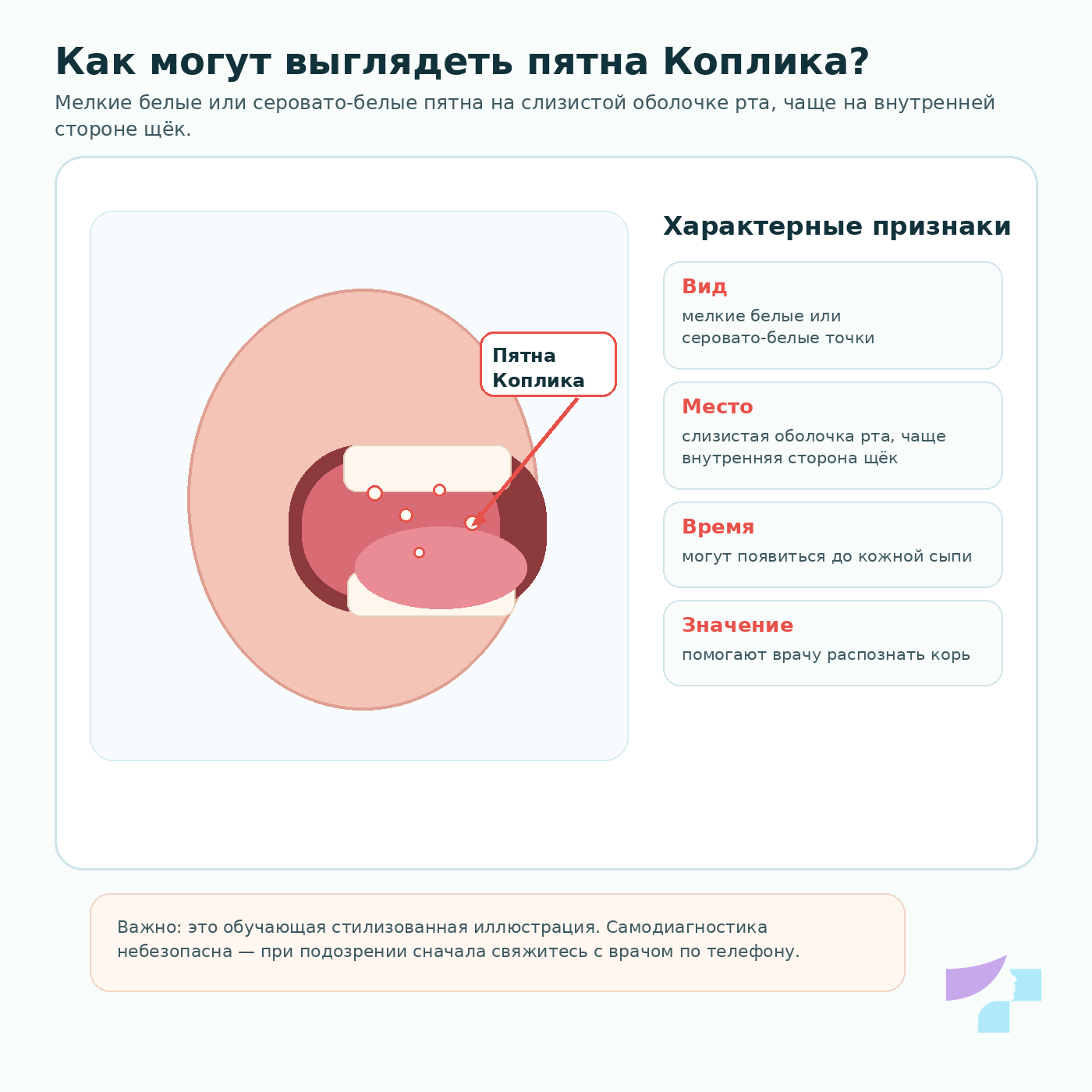 Пятна Коплика при кори: мелкие белые пятна на слизистой оболочке рта