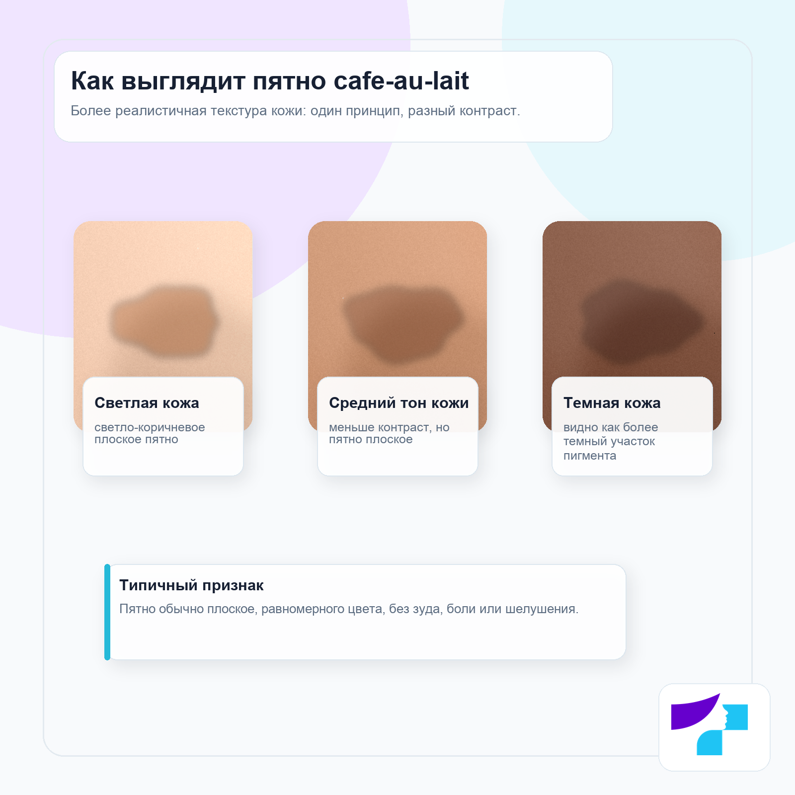 Пятно cafe-au-lait на разных тонах кожи Пятно cafe-au-lait на разных тонах кожи: плоский светло- или темно-коричневый участок пигментации с разной выраженностью контраста
