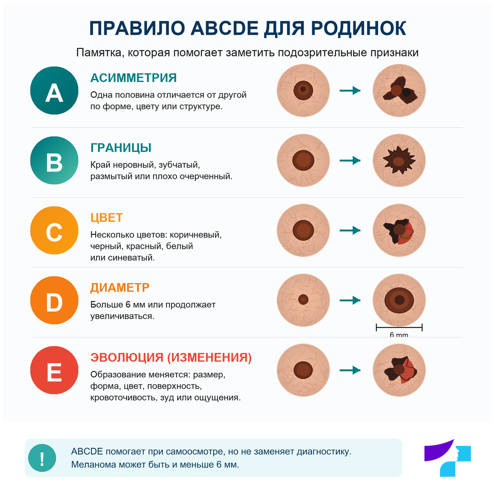Правило ABCDE для родинок