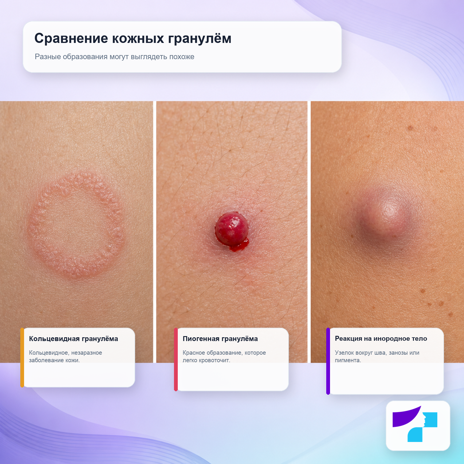 Сравнение кожных гранулём: кольцевидная гранулёма, пиогенная гранулёма и реакция на инородное тело