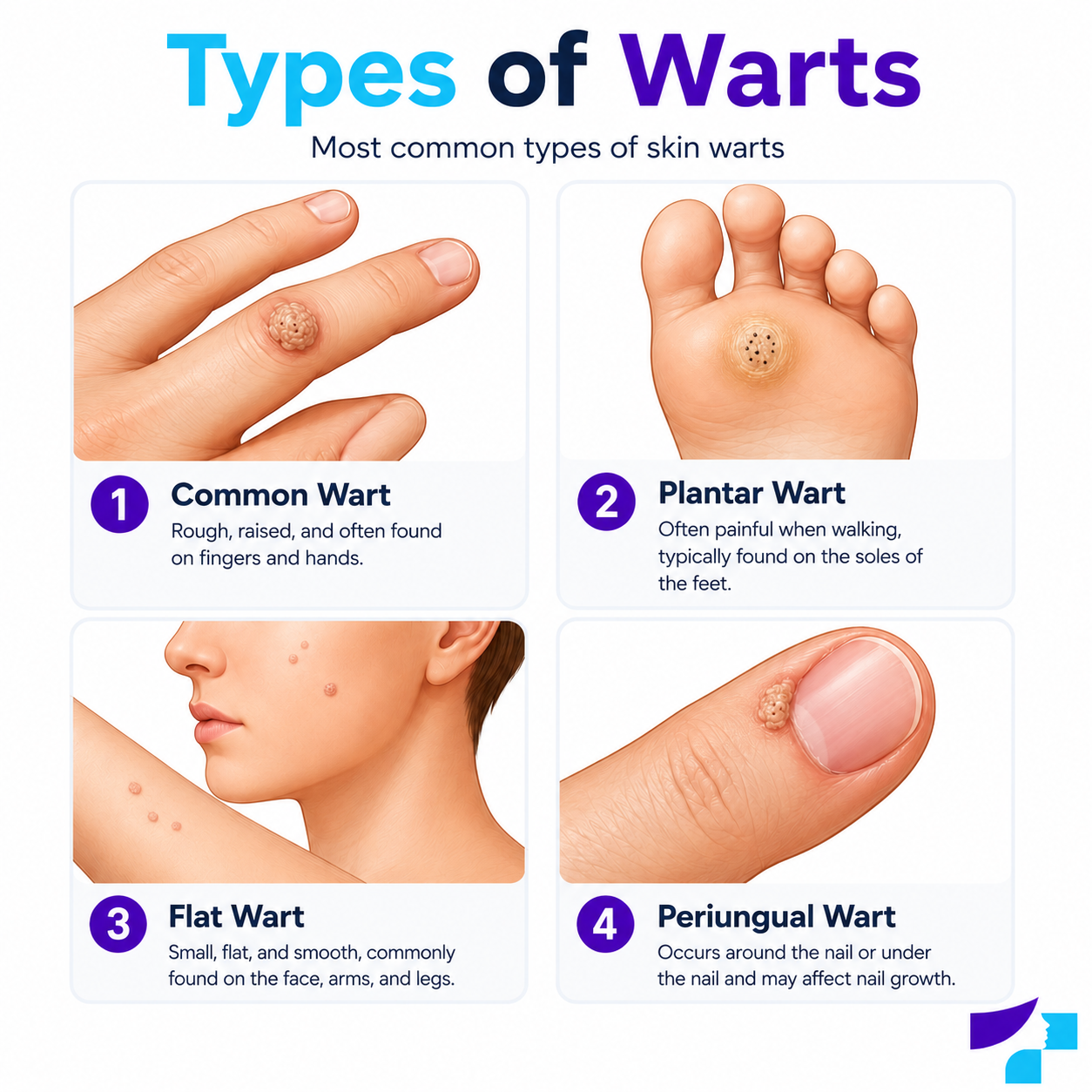 Types of warts Common types of warts: common warts, plantar warts, flat warts and periungual warts