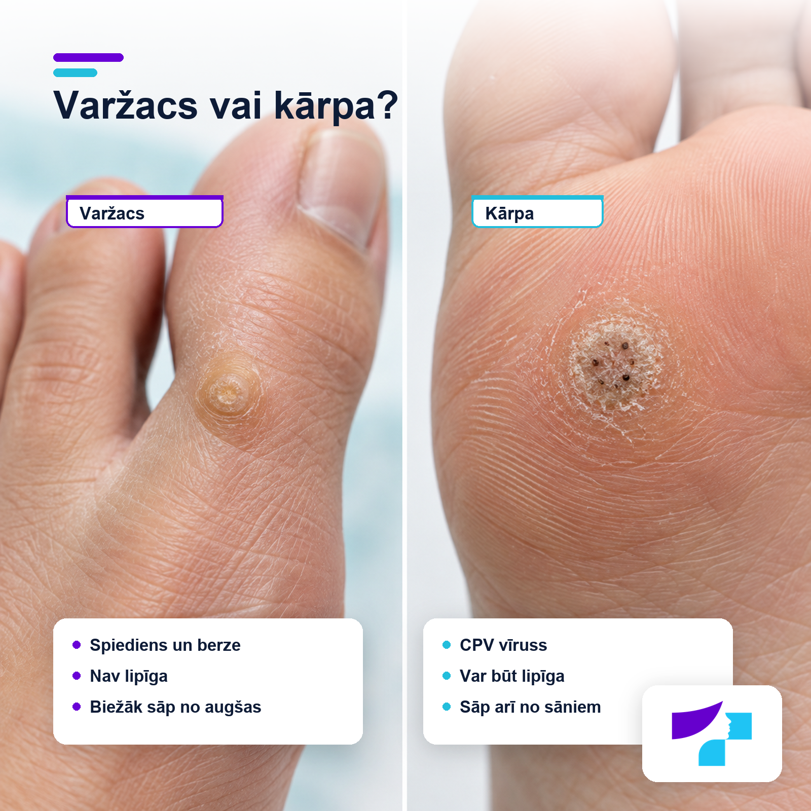 Varžacs un kārpas atšķirības uz pēdas pēc cēloņa, lipīguma un sāpju veida