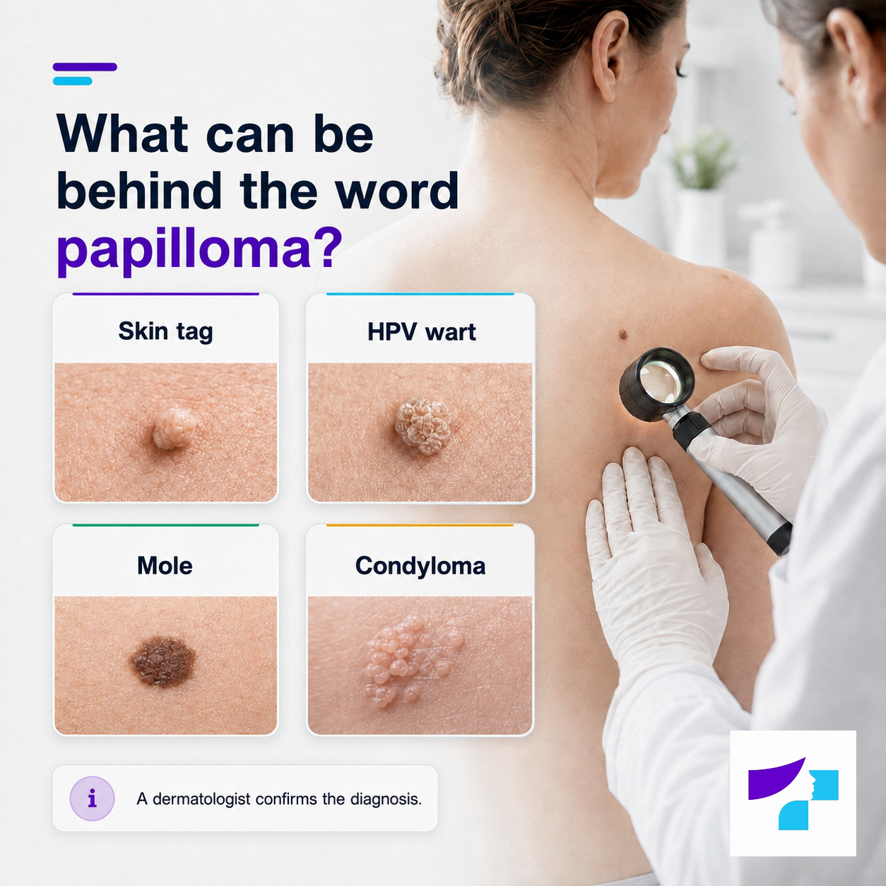 What can be behind the word papilloma What can be behind the word papilloma: skin tag, HPV wart, mole or condyloma