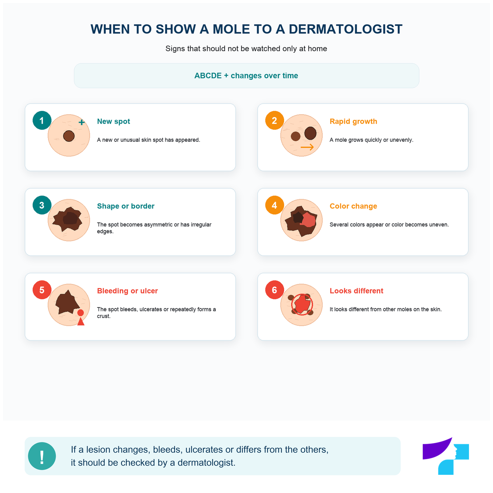 Warning signs when a mole should be shown to a dermatologist
