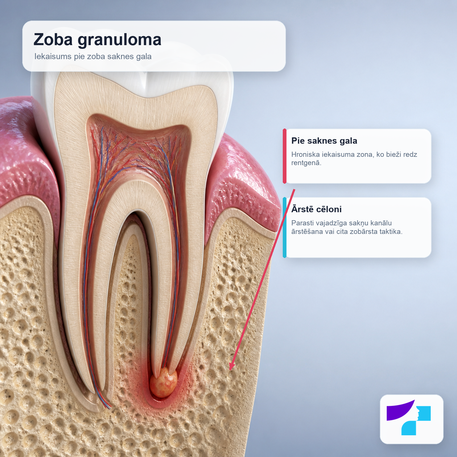 Zoba granuloma pie saknes gala Zoba granuloma jeb periapikāla granuloma kā hroniska iekaisuma zona pie zoba saknes gala